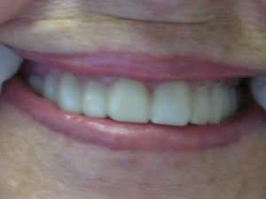ACTUAL PATIENT WEARING SNAP-ON SMILE