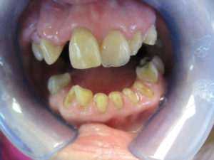 Snap-On-Smile patient before
