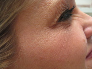 Botox right eye after