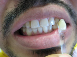 Whitening patient after