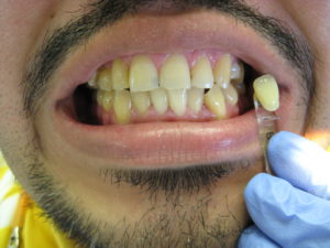 Whitening patient before