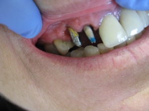 Before dental implant