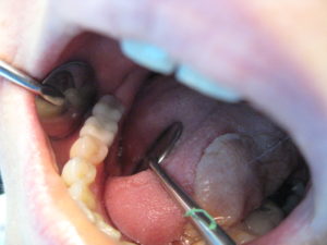 After dental implant