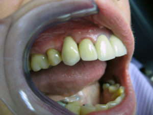 After dental implant
