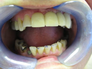 Implant after