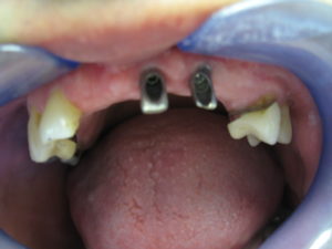 Implant before