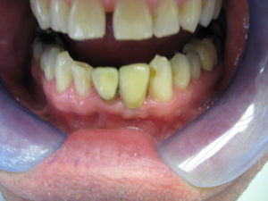 Implant after